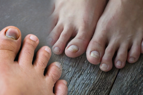 உங்க நகங்கள் இப்படி இருக்கா? அலட்சியம்வேண்டாம்; காத்திருக்கும் அபாயம் | If Cholesterol Levels Changes In The Nails