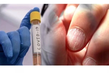 உங்க நகத்தை வைத்தே கொரோனா இருக்கா? இல்லையா? சொல்லிடலாம்: எப்படி தெரியுமா?