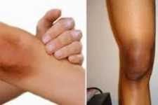 முழங்காலில் உள்ள கருமை நீங்க வேண்டுமா? உங்களுக்கான அற்புத தீர்வு