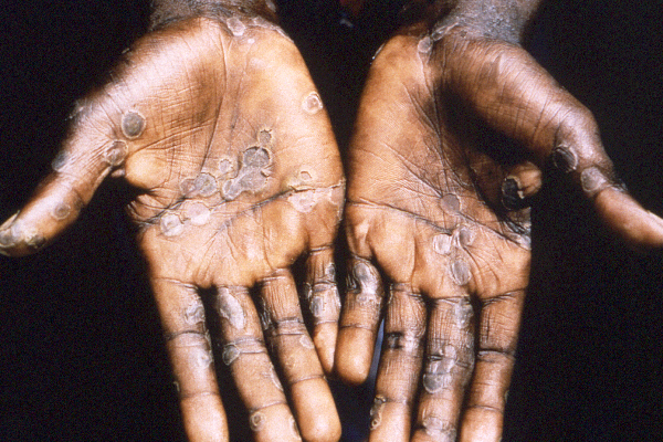 வேகமாக பரவும் குரங்கு அம்மை நோய்...இந்தியாவிலும் பரவ வாய்ப்பா? - தமிழ்நாடு