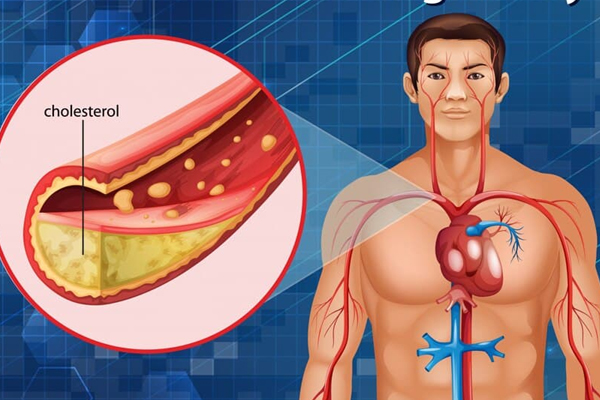 இந்த தவறுகளை மட்டும் செய்யாதீங்க.... கொலஸ்ட்ரால் தாறுமாறாக அதிகரிக்கும் | These Mistakes Avoid Improve Cholesterol Level இந்த தவறுகளை மட்டும் செய்யாதீங்க.... கொலஸ்ட்ரால் தாறுமாறாக அதிகரிக்கும் | These Mistakes Avoid Improve Cholesterol Level
