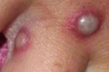 இஸ்ரேலில் ஒருவருக்கு குரங்கம்மை