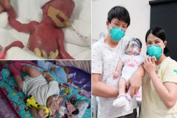 பிறக்கும் போது 212 கிராம் இருந்த குழந்தையின் தற்போதைய நிலை! வியக்க வைத்த மருத்துவர்கள்