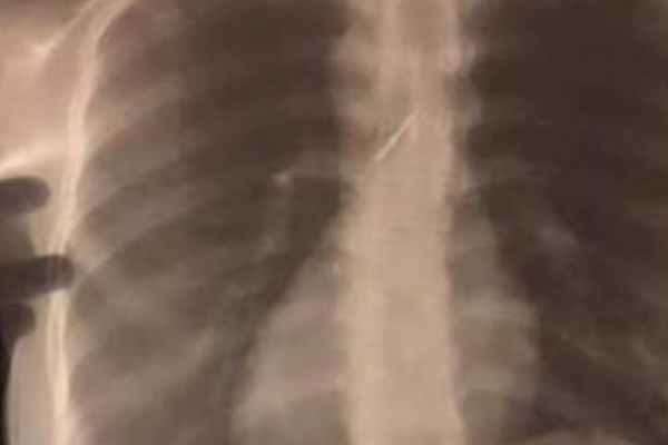கிளிநொச்சியில் பல் வலியால் வைத்தியசாலைக்கு சென்ற யுவதிக்கு நேர்ந்த அதிர்ச்சி சம்பவம் | Girl Went To Hospital In Kilinochchi Due Toothache