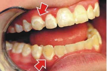 அசிங்கமான மஞ்சள் நிற பற்களை நொடியில் வெள்ளையாக்கனுமா? இந்த சக்தி வாய்ந்த பொருட்கள் போதும்!