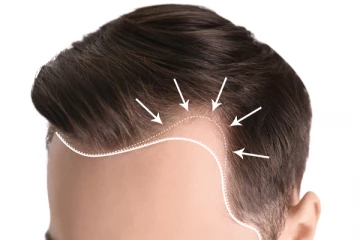 வழுக்கைத் தலையில் முடி கிடுகிடுனு வளர இந்த ஒரே ஒரு பொருள் போதும்.... இப்படி யூஸ் பண்ணுங்க!