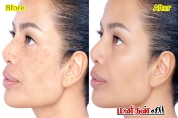 முகத்தின் விடாப்பிடியான கரும்புள்ளியை எப்படி இயற்கையாக நீங்குவது?