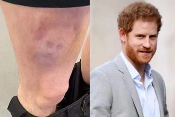 கால்பந்து வீரரின் காலில் பட்ட காயத்தில் இளவரசர் ஹரியின் முகம்!