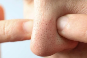 முகத்தின் பொலிவை மங்கச் செய்யும் Whiteheads; எளிய முறையில் தீர்வு காண்பது எப்படி?