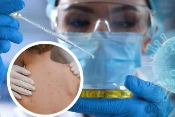 குரங்கு அம்மையின் முக்கிய அறிகுறிகள் இவைதான்! அவசியம் தெரிஞ்சிகோங்க