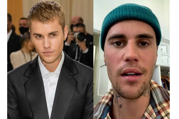 ஜஸ்டின் பீபருக்கு வந்த நோய்! முகத்தின் ஒரு பக்கம் அசையவில்லை | Ramsay Hunt Syndrome In Tamil