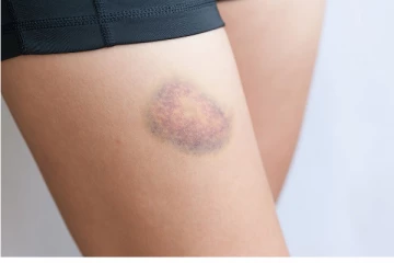 காலில் இந்த சின்ன அறிகுறி இருக்கா? உயிருக்கு ஆபத்து...புற்றுநோயோட ஆரம்பம்!  நீரிழிவும் ஈசியா வரும்!