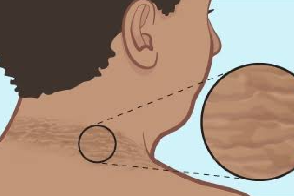 කොච්චර සුදු වුණත් බෙල්ල කළුයි ද? ඔයත් මෙහෙම කරා නම් ලැජ්ජා වුණ කාලේ ඉවරයි | Dark Neck Acanthosis Nigricans Explained කොච්චර සුදු වුණත් බෙල්ල කළුයි ද? ඔයත් මෙහෙම කරා නම් ලැජ්ජා වුණ කාලේ ඉවරයි | Dark Neck Acanthosis Nigricans Explained