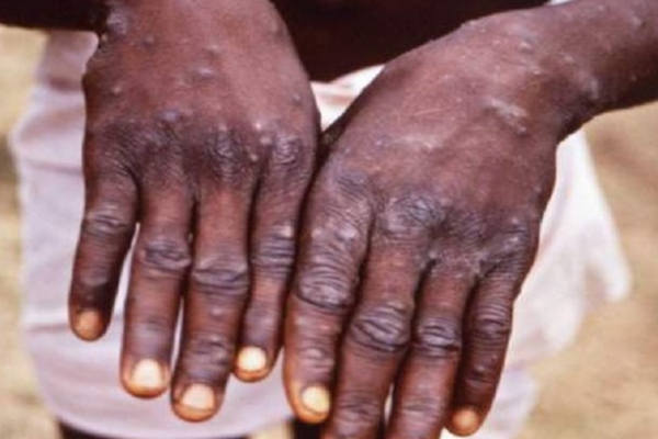 ஆட்டிப் படைக்கும் குரங்கு அம்மை! நோய் பாதித்தால் என்ன செய்ய வேண்டும்? | Monkeypox Symptoms Treatment In Tamil