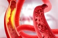 இதய ரத்த நாளங்களில் எப்படி அடைப்பு ஏற்படுகிறது? மருத்துவரின் விளக்கம்