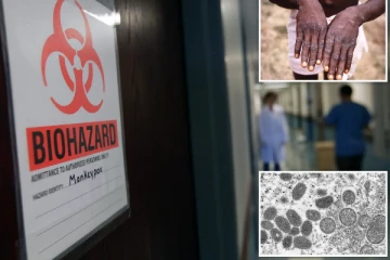 சமூக பரவலாக மாறும் குரங்கம்மை: மக்கள் விழிப்புடன் இருக்க வேண்டுகோள்!