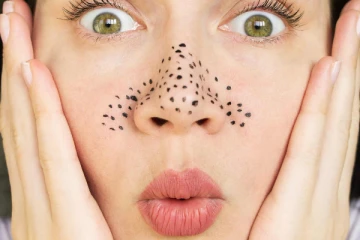 முகத்துல இருக்கிற கரும்புள்ளி மறையவே மாட்டேங்குதா? இத மட்டும் பண்ணுங்க... காணாமல் போயிடும்