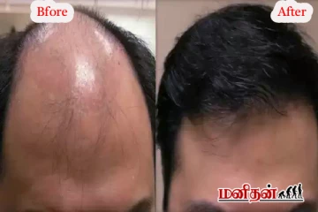 வழுக்கையான இடத்தில் 20 நாட்களில் முடி வளரும் சீரம் - ஆய்வாளர்கள் கண்டுபிடிப்பு