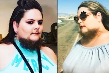 17 வருடங்களாக முகத்தில் தாடியுடன் இளம்பெண் - காரணம் இதுதான்!