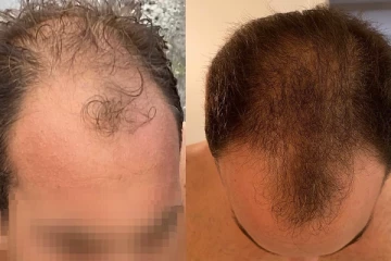 வலுக்கை தலையிலும் புதிய முடி முளைக்கனுமா?  இதை ஒரு துளி விட்டு தடவுங்க!