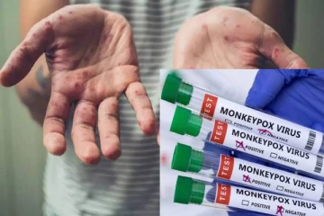 26 நாடுகளில் பரவிய குரங்கு அம்மை! WHO வெளியிட்ட தகவல்