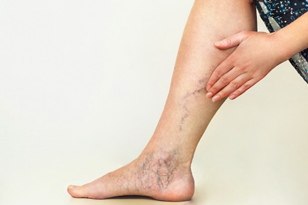 நீங்க கர்ப்பிணியா? இந்த நேரத்தில் ஆபத்தான வெரிகோஸ் வெயின் வரும்!  எச்சரிக்கை அறிகுறிகள் | Pregnancy Varicose Veins Symptoms