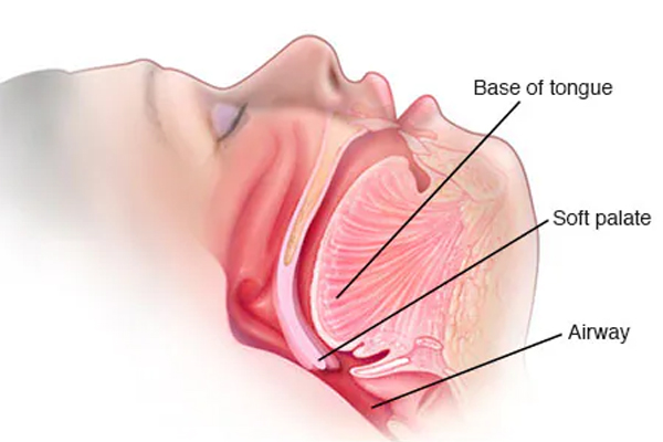 குறட்டை விடுவதை அலட்சியமாக விடாதீங்க... மிகப்பெரிய நோய்க்கு அறிகுறியாக இருக்கும் | Snoring Alert Diabetes And Heart Risks குறட்டை விடுவதை அலட்சியமாக விடாதீங்க... மிகப்பெரிய நோய்க்கு அறிகுறியாக இருக்கும் | Snoring Alert Diabetes And Heart Risks