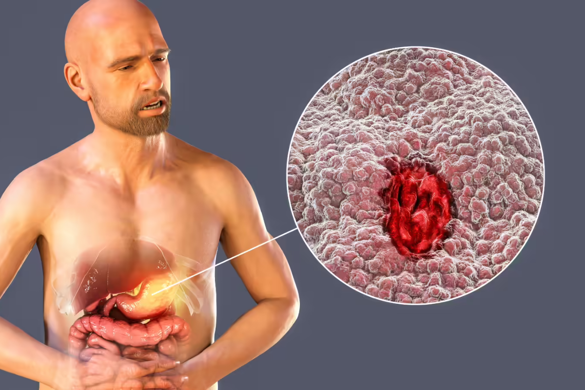 Stomach Ulcer: வயிற்று புண்கள் ஏற்படுவதற்கு முக்கியமான காரணம் | Reason For Stomach Ulcer How To Prevent It Stomach Ulcer: வயிற்று புண்கள் ஏற்படுவதற்கு முக்கியமான காரணம் | Reason For Stomach Ulcer How To Prevent It