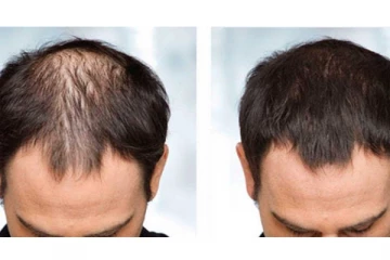 ஆண்களே வழுக்கை விழுகிறது என்ற கவலையா? மறக்காம இதை மட்டும் செய்திடுங்கள்