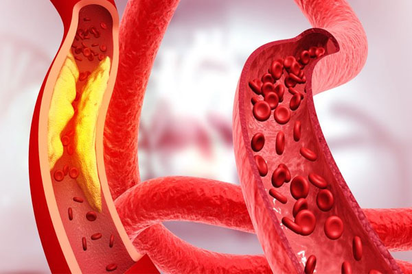 Fat in blood vessels