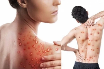 මන්කි පොක්ස් වැඩි අවධානමක් තියෙන්නෙ මේ සම්බන්ධතා ඇති අයටලු..දැන්ම සබඳතා නතර කරන්න..