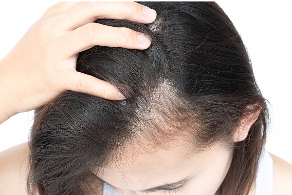 நீரிழிவு நோயாளிகளுக்கு முடி உதிர்வு நாளுக்கு நாள் அதிகரிக்கும்...ஏன் தெரியுமா? தவிர்ப்பது எப்படி? | Diabetes Hair Loss