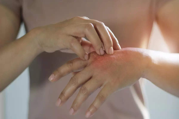 தொழுநோயால் பாதிக்கப்பட்டுள்ள பாடசாலை மாணவர்கள் | School Students Affected By Leprosy