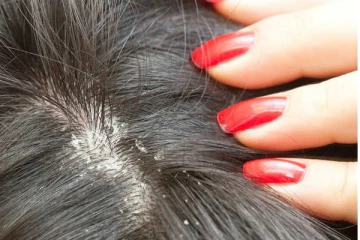 தாங்க முடியாத பொடுகு தொல்லையா?  இந்த சாற்றை ஒரு துளி எடுத்து பயன்படுத்துங்க!