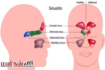 அடிக்கடி தொல்லை கொடுக்கும் சைனஸ்: எவ்வாறு நிவாரணம் பெறலாம்?