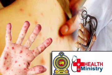 நாட்டில் மீண்டும் தட்டம்மை நோய் பரவும் அபாயம் - சுகாதார அமைச்சு எச்சரிக்கை