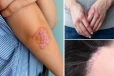 சருமத்தை சேதப்படுத்தும் சொரியாசிஸ் நோய்- யாருக்கெல்லாம் வரும் தெரியுமா?