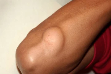 உடலில் கட்டிகள் வருவதற்கான காரணம் என்ன? கட்டிகள் மறைய இப்படி செய்யுங்கள்