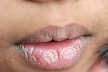 கருப்பான உதடுகளை இளஞ்சிவப்பு நிறமாக மாற்றும் வைத்தியம் - எப்படி தெரியுமா?