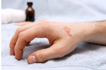 தீக்காயத்தால் ஏற்பட்ட வடு மறையலயா? இப்படி பண்ணுங்க மறைஞ்சிடும்