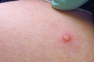 ரொறன்ரோவில் குரங்கம்மை நோய்த் தாக்கம் அதிகரிப்பு