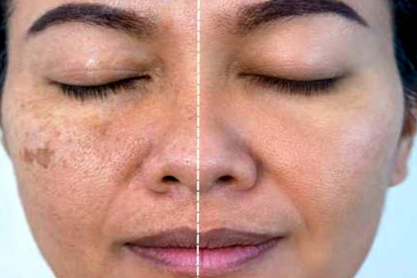 இந்த காயை தடவி பாருங்க.. முகத்திலுள்ள பருக்கள் காணாமல் போகும் | Homemade Pimple Marks For Pigmentation In Tamil