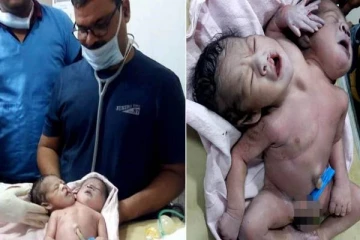 2 தலை, 3 கைகளுடன் பிறந்த அதிசயக் குழந்தை - மருத்துவமனையில் தீவிர சிகிச்சை