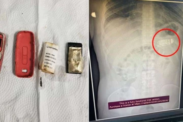 ‘போனை முழுங்கிட்டேன்’ - இளைஞரால் அதிர்ந்த மருத்துவமனை நிர்வாகம்