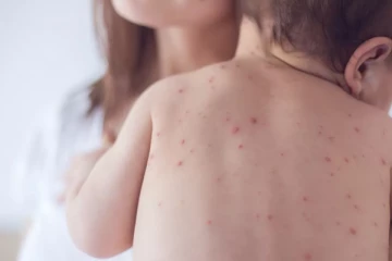 பிரித்தானியாவில் வேகமாகப் பரவும் விக்டோரியா யுக நோய்க்கு அயர்லாந்தில் ஒருவர் பலி: ஒரு அவசர செய்தி