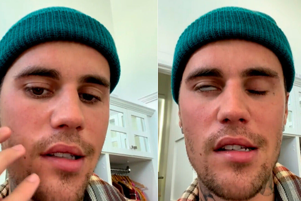 ஜஸ்டின் பீபருக்கு வந்த நோய்! முகத்தின் ஒரு பக்கம் அசையவில்லை | Ramsay Hunt Syndrome In Tamil