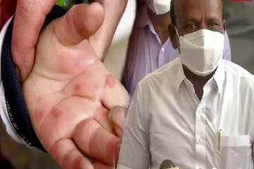 கொரோனா ,குரங்கு அம்மையை அடுத்து பரவும் தக்காளி காய்ச்சல்