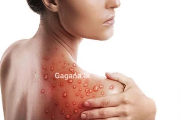 ඇග හිරිවැටෙන මන්කිෆොක්ස් ගැන භයානක අණාවරණයක් - සැක පුද්ගලයින් 18,000ක්