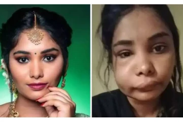 மயக்க ஊசிக்கு பதில் ஆசிட்டை செலுத்திய மருத்துவர்! பிரபல நடிகையின் கோர தோற்றத்துக்கான அதிர்ச்சி காரணம்?