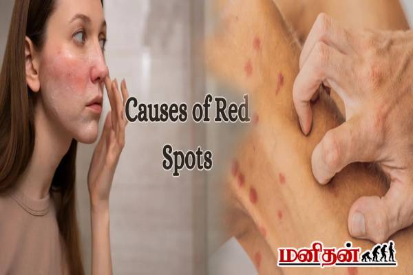 Red Spots on Skin: சருமத்தில் தோன்றும் சிவப்பு புள்ளிகள் ஆபத்தானதா? மருத்துவ விளக்கம் | Whats The Reson Behaind Red Spots On Skin